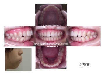 前突リンガル.001.jpg