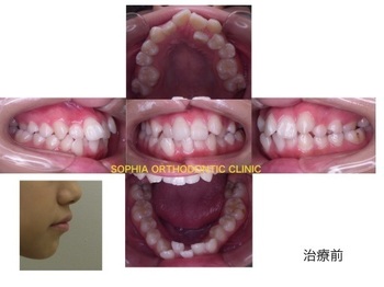 叢生抜歯.001.jpg